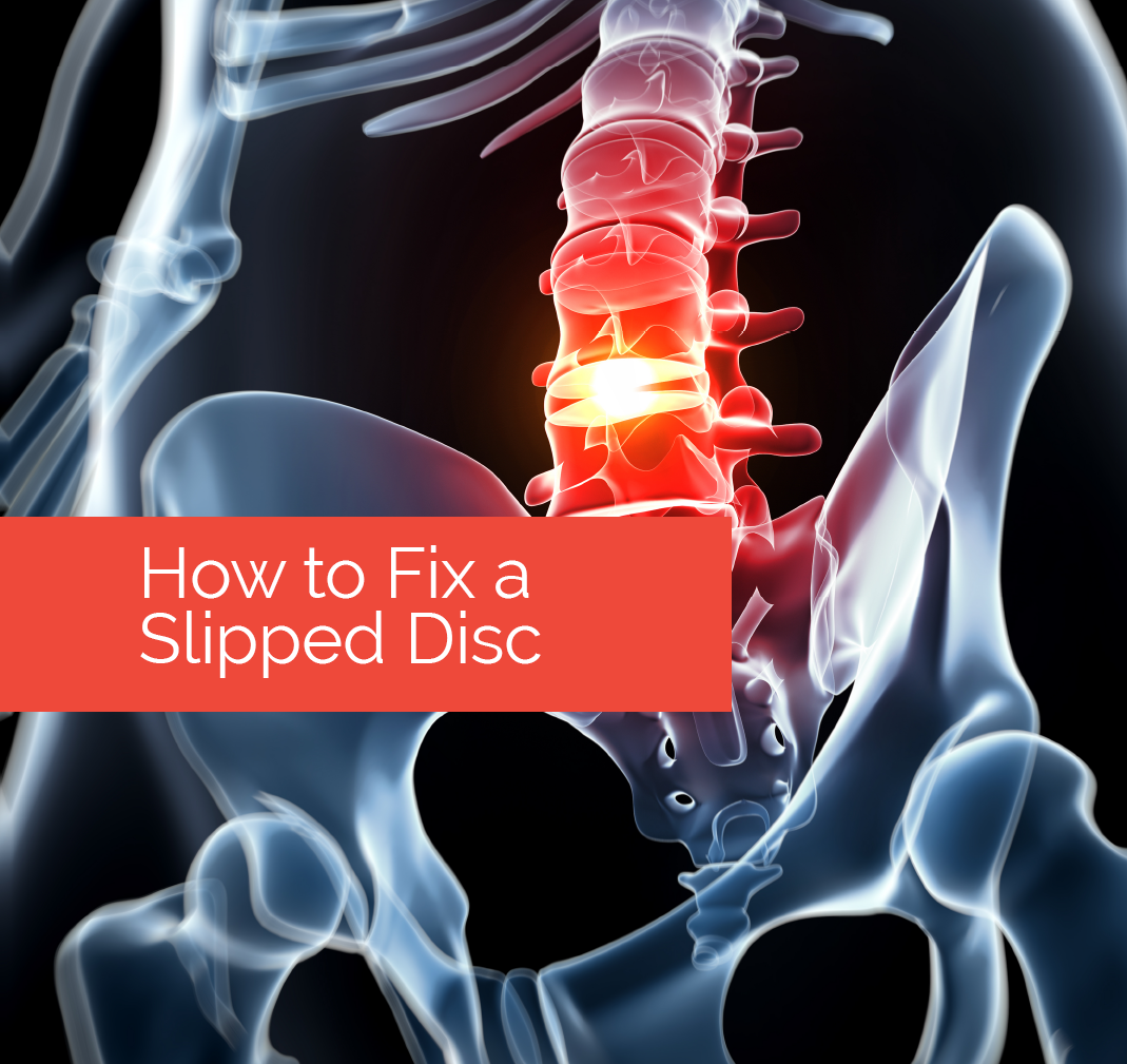 Does a slipped disc require surgery?